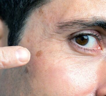 Skin Cancer Treatment Options in the 21st Century 2